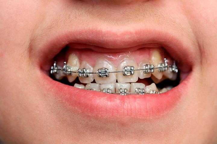 Image result for braces on crooked teeth